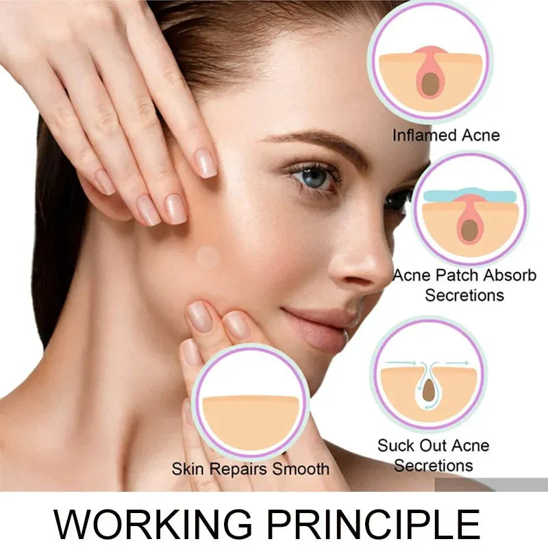 Face Acne Pimple Patch – 36 Hydrocolloid Spot Healing Strips